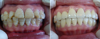 牙齿美白前后对比图