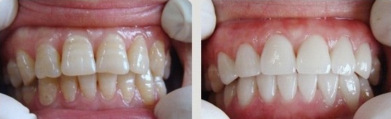 牙齿美白前后对比图