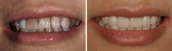 牙齿美容前后对比图