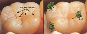 牙有个窟窿怎么补牙 牙有个窟窿怎么补牙