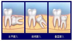 在郑州拔一颗智齿要多少钱