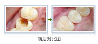 蛀牙要不要拔掉