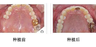 牙齿缺失后不镶牙行吗