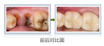 孩子6岁有虫牙