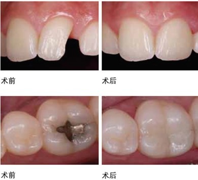 缺牙补牙多少钱